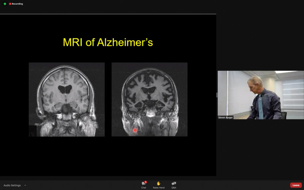 The brain scan of a normal brain (left) and an ALzheimer's brain (right) have differences in regards to loss of brain matter. (THE SIGNPOST/ ISRAEL CAMPA)